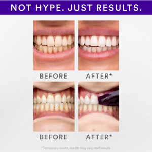 Hismile V34 Whitening Strips balinimo juostelės 14 vnt